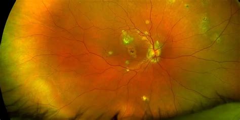 Discover How an Experienced Optometrist Can Help You Find Relief From Ocular Histoplasmosis